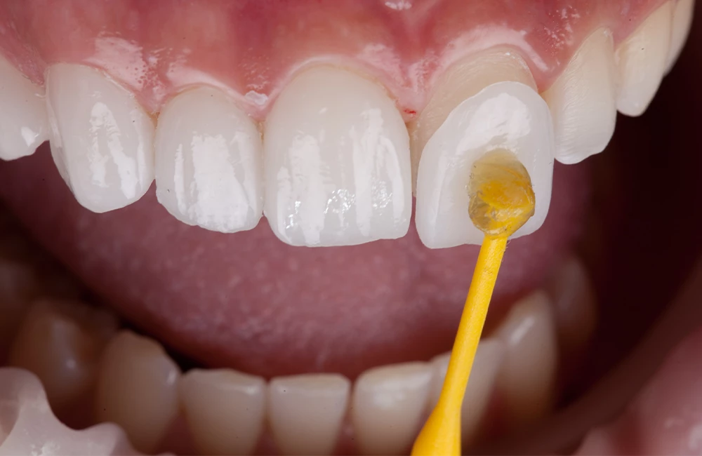 Veneers in Dubrovnik — Costs Compared